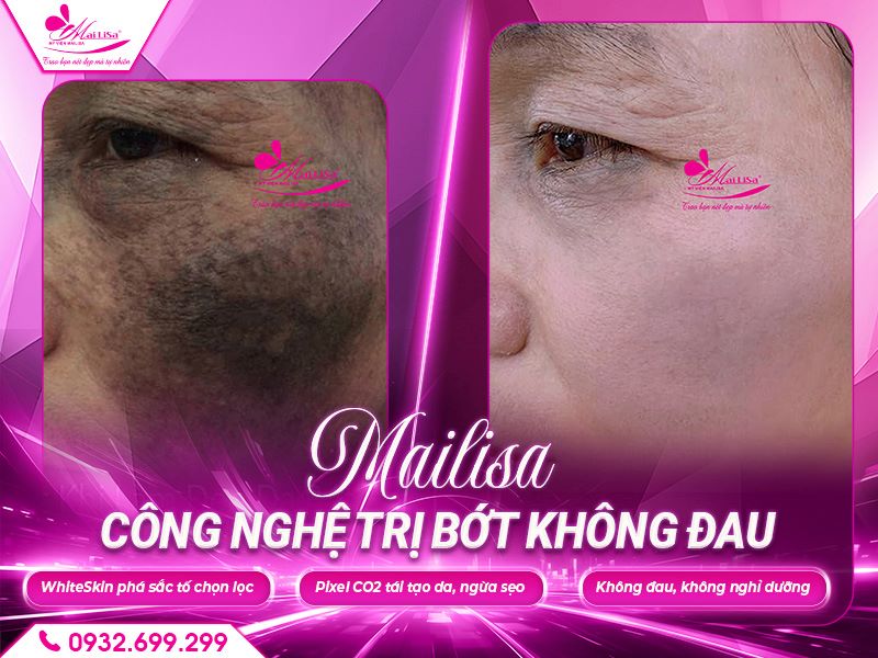 mailisa-cong-nghe-tri-bot-khong-dau