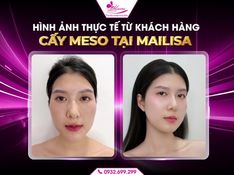meso-an-toan-tai-mailisa