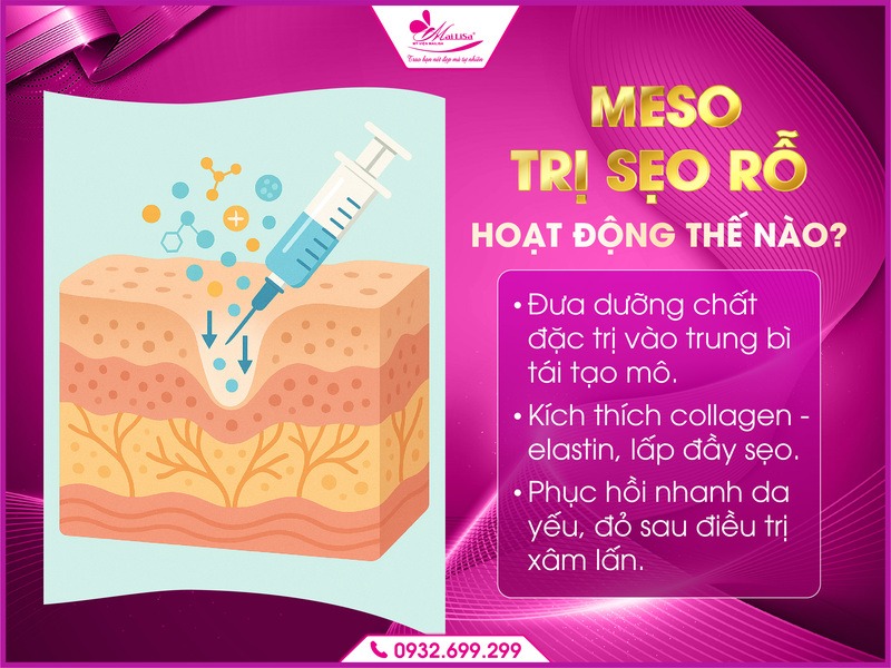meso-giup-lam-day-seo-ro-mailisa