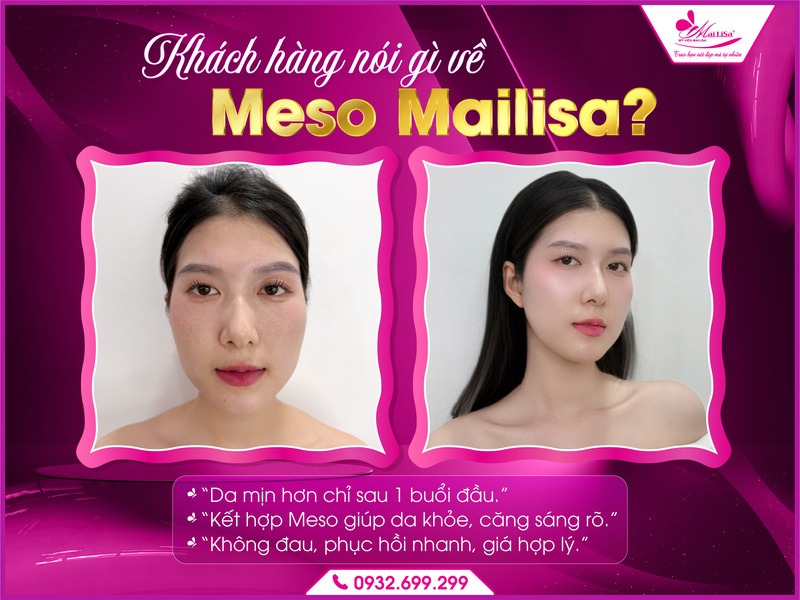 meso-giup-lam-day-seo-ro-mailisa