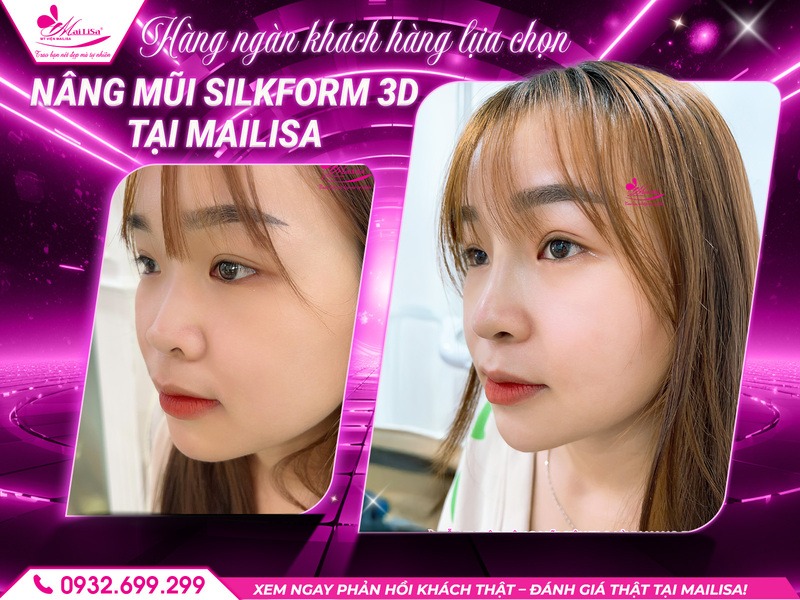 nang-mui-silkform-3d-giu-duoc-bao-lau