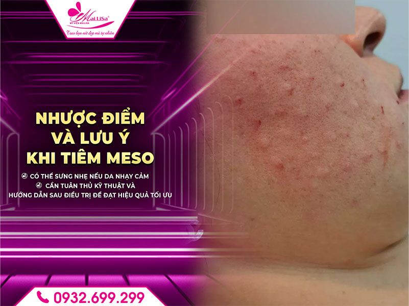 nhuoc-diem-va-luu-y-khi-tiem-meso