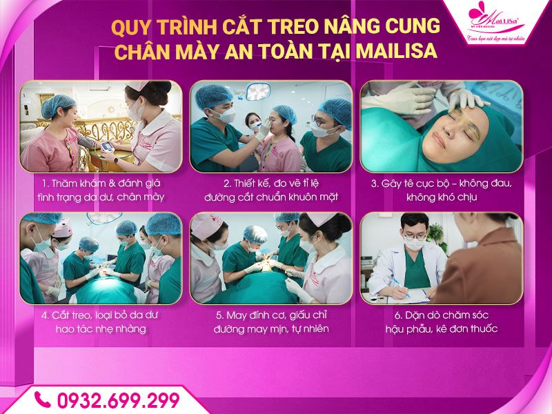 quy-trinh-cat-treo-mailisa