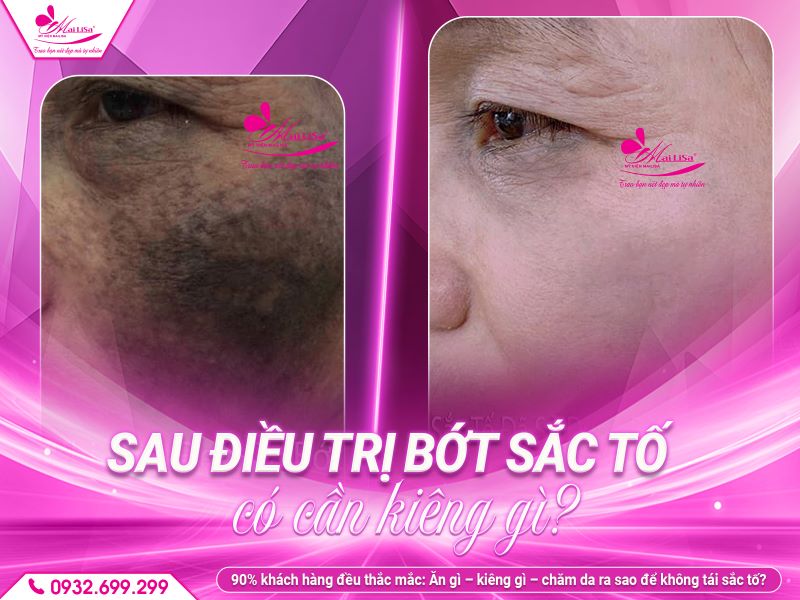 sau-dieu-tri-bot-sac-to-can-kieng-gi