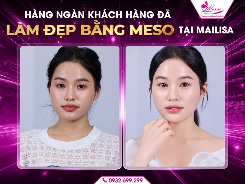 sau-khi-lam-dep-da-bang-meso-can-kieng-gi
