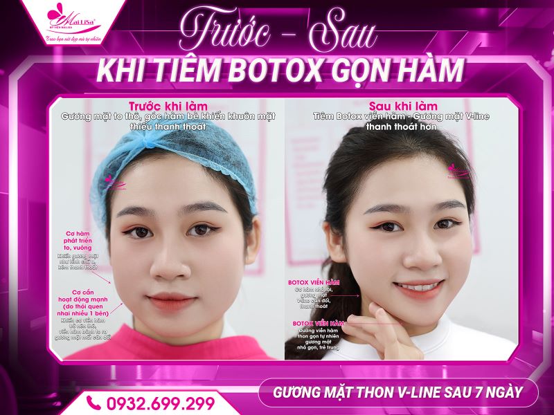 truoc-sau-khi-tiem-botox-gon-ham