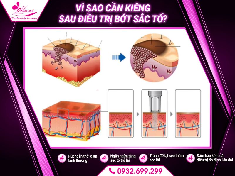 vi-sao-can-kieng-sau-dieu-tri-bot-sac-to
