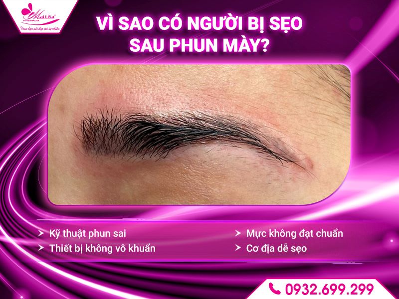 vi-sao-co-nguoi-bi-seo-sau-phun-may