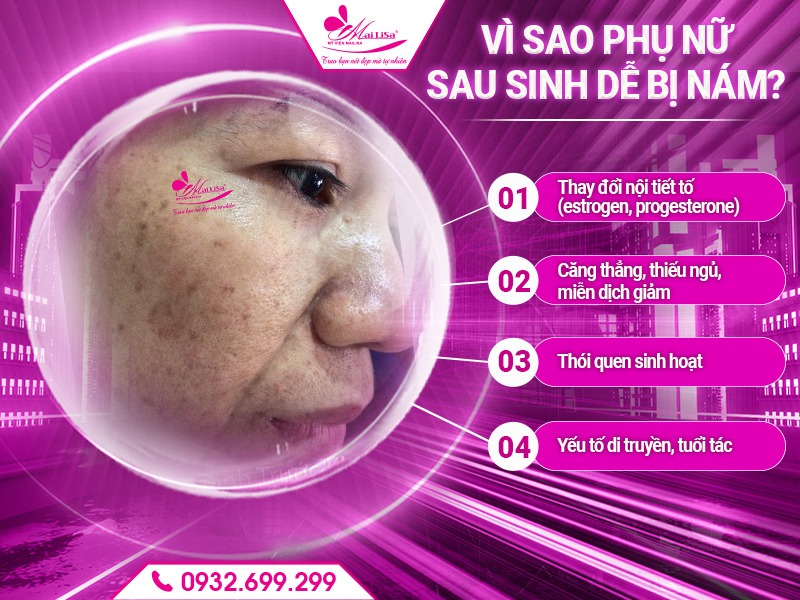 cong-nghe-tri-nam-cho-phu-nu-sau-sinh