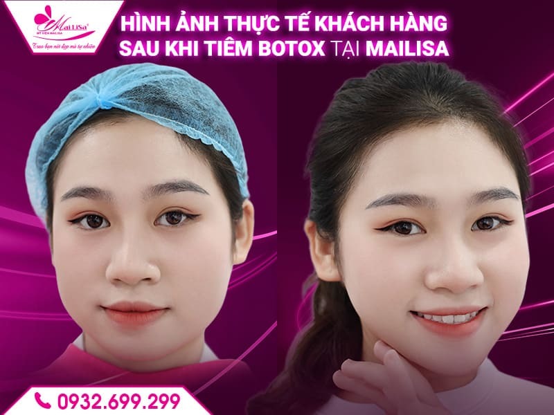 tiem-botox-co-bi-bien-chung-khong