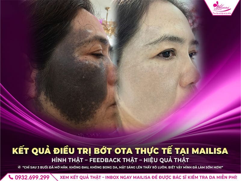 bot-ota-la-gi