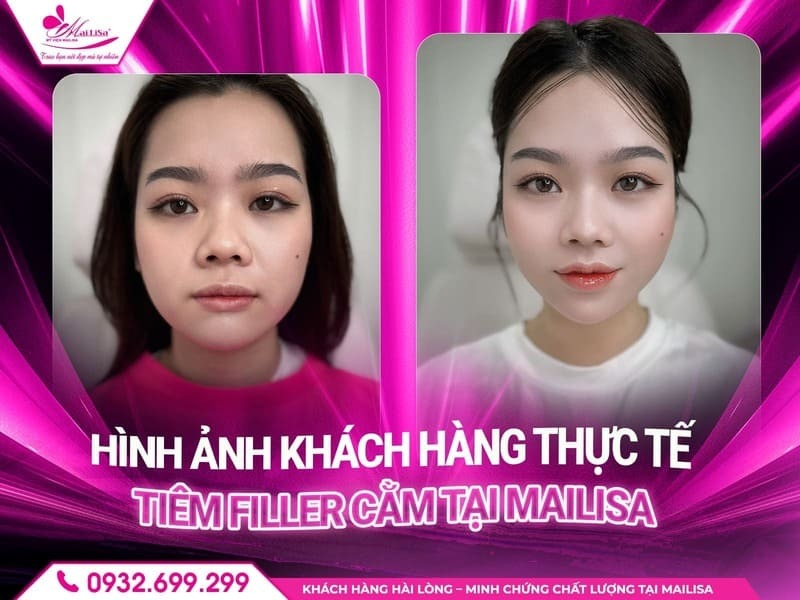 cach-cham-soc-sau-tiem-filler-cam
