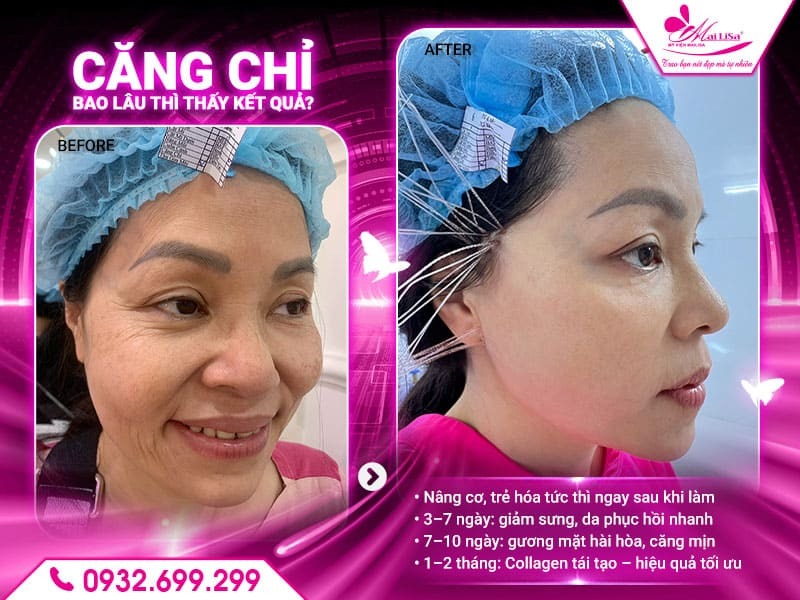 cang-chi-bao-lau-thi-thay-ket-qua