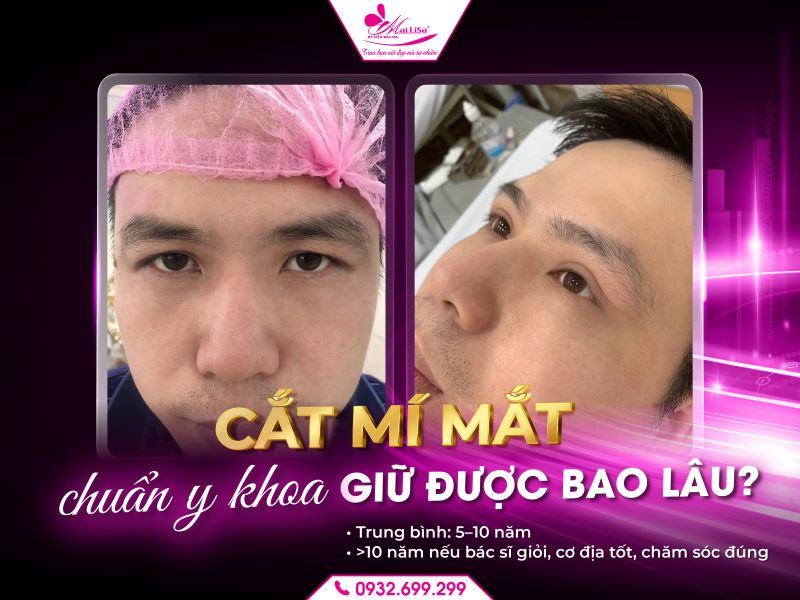 cat-mi-mat-giu-duoc-bao-lau-chuan-y-khoa