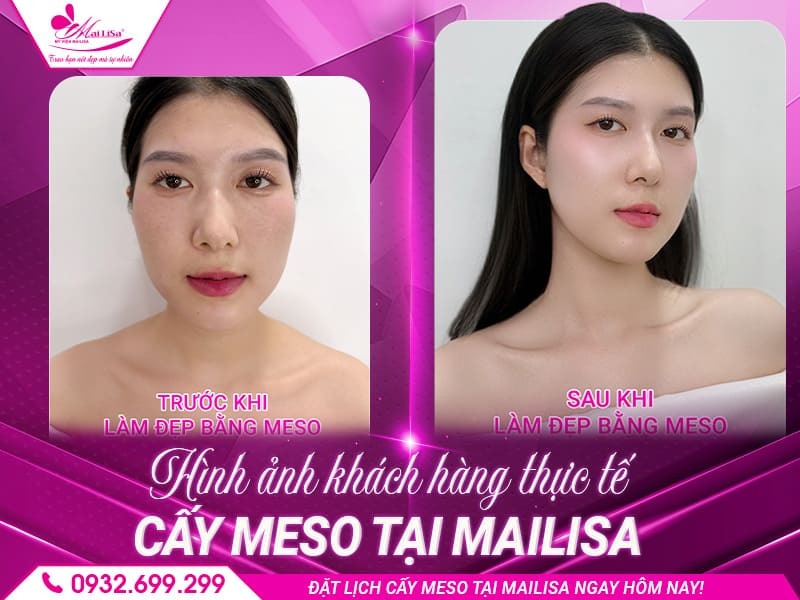 cay-meso-co-giup-mo-nam-khong