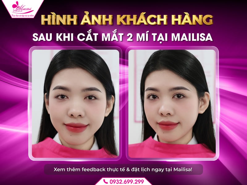 cham-soc-sau-cat-mi-mat