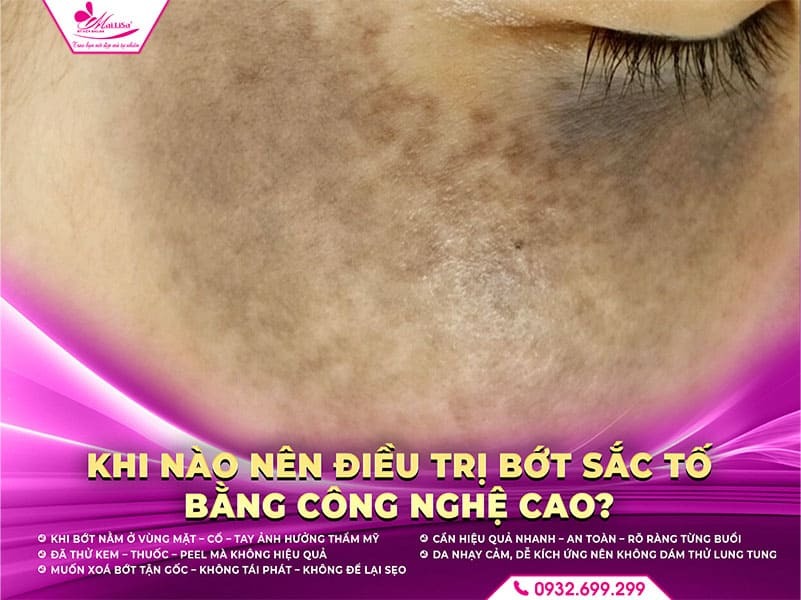 dieu-tri-bot-sac-to