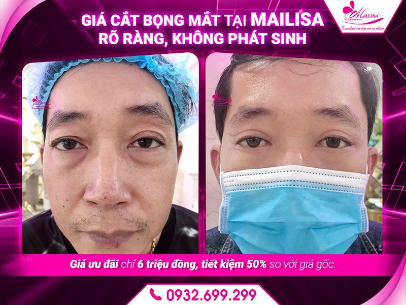 gia-cat-bong-mat-tai-mailisa