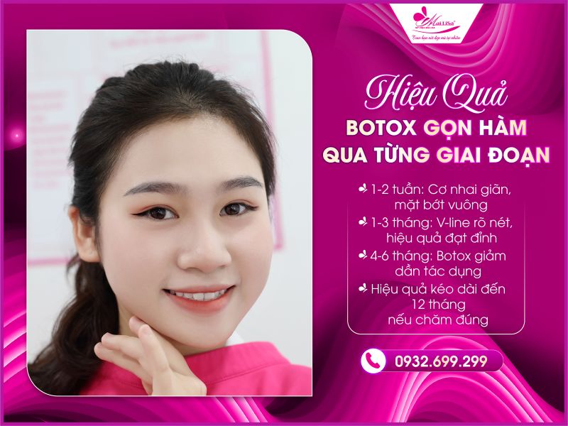 hieu-qua-botox-gon-ham-qua-tung-giai-doan