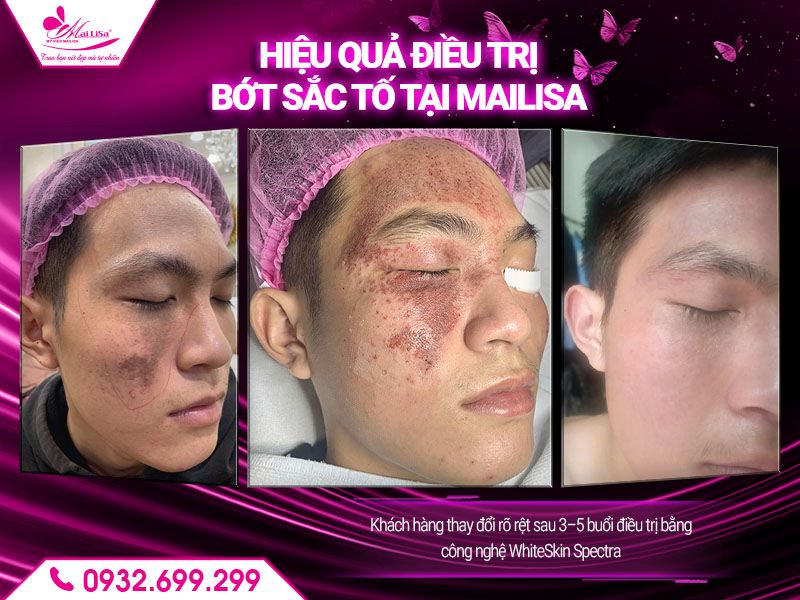 hieu-qua-dieu-tri-bot-sac-to-tai-mailisa