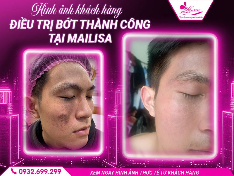 hinh-anh-khach-hang-dieu-tri-bot-thanh-cong-tai-mailisa