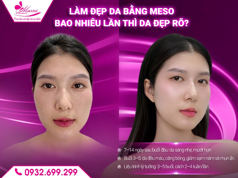 lam-dep-da-bang-meso-bao-nhieu-lan-thi-da-dep-ro