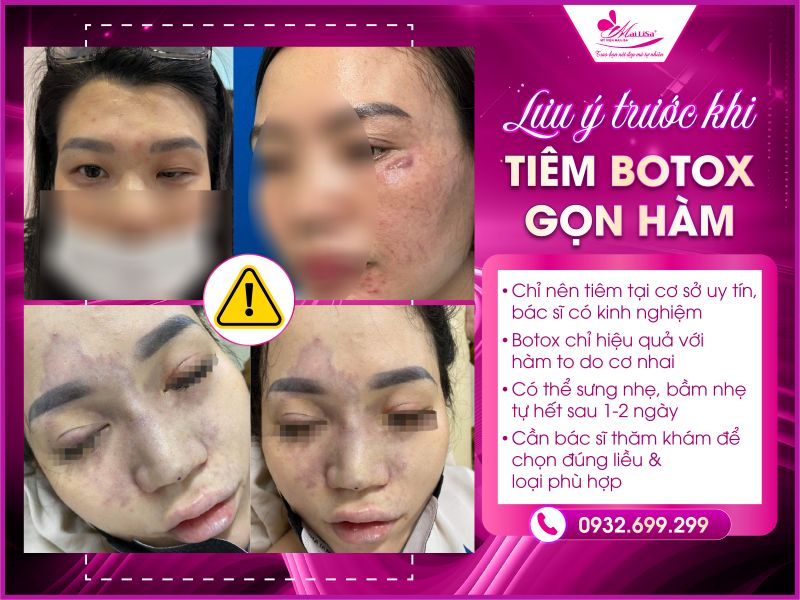 luu-y-truoc-khi-tiem-botox-gon-ham