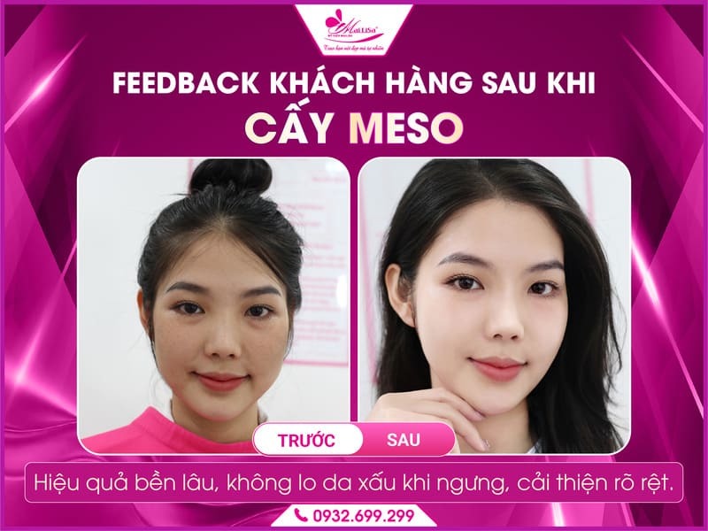 ngung-cay-meso-da-co-xau-di-khong