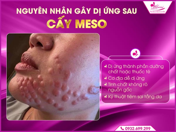 nguy-co-di-ung-sau-khi-cay-meso