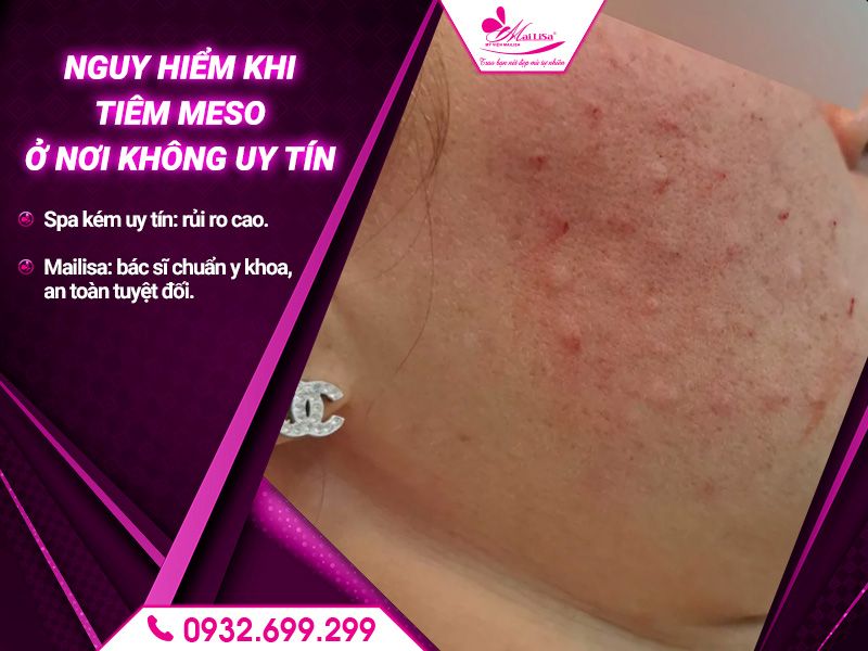 nguy-hiem-khi-tiem-meso-o-noi-khong-uy-tin
