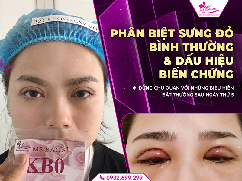 phan-biet-sung-do-binh-thuong-dau-hieu-bien-chung
