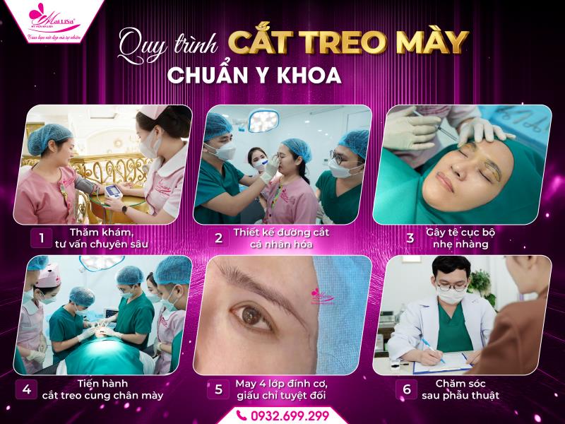 quy-trinh-cat-treo-may-chuan-y-khoa-tai-mailisa