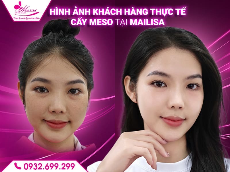 quy-trinh-cay-meso-tai-mailisa