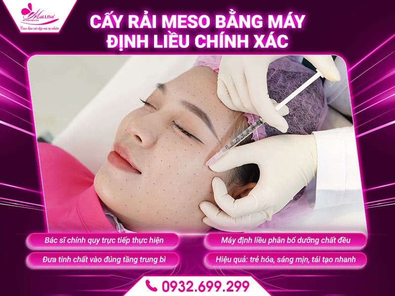 quy-trinh-cay-meso-tai-mailisa
