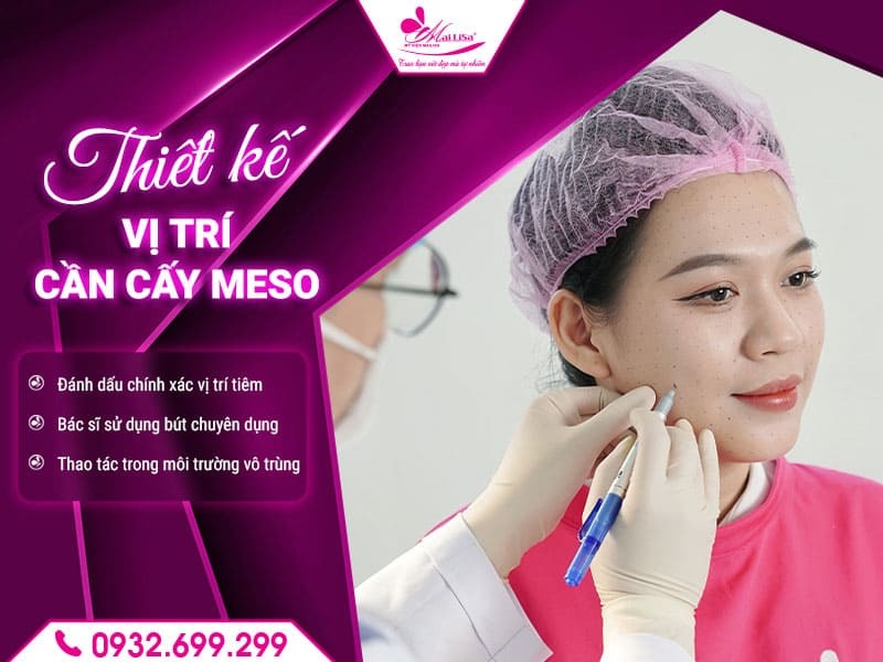 quy-trinh-cay-meso-tai-mailisa
