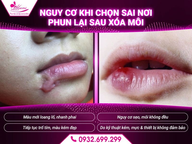 sau-khi-xoa-phun-moi-co-can-phun-lai-khong