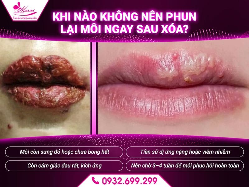 sau-khi-xoa-phun-moi-co-can-phun-lai-khong