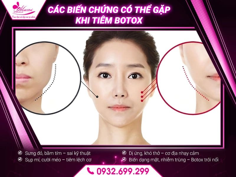tiem-botox-co-bi-bien-chung-khong