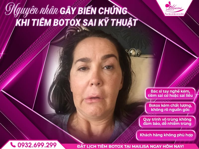 tiem-botox-sai-ky-thuat-gay-bien-chung-gi