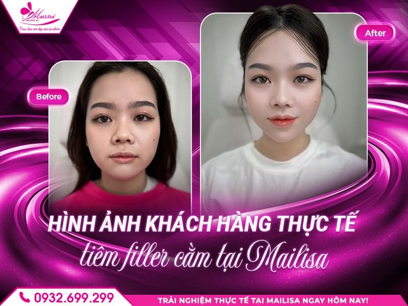 tiem-filler-cam-bao-lau-thi-lanh