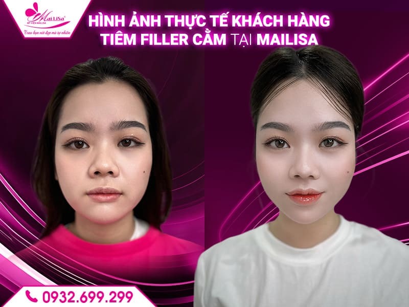 tiem-filler-cam-co-hieu-qua-lau-dai-khong