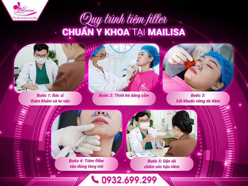 tiem-filler-cam-co-hieu-qua-lau-dai-khong
