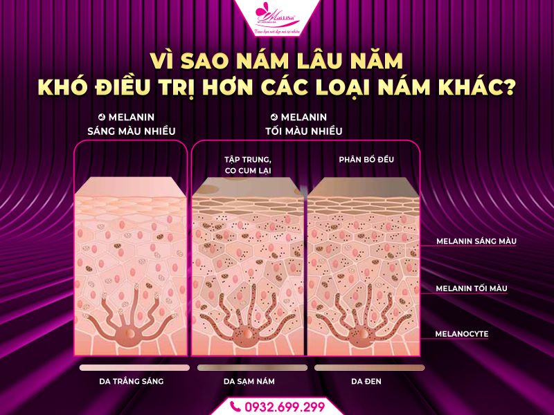 vi-sao-nam-lau-nam-kho-dieu-tri-hon-cac-loai-nam-khac