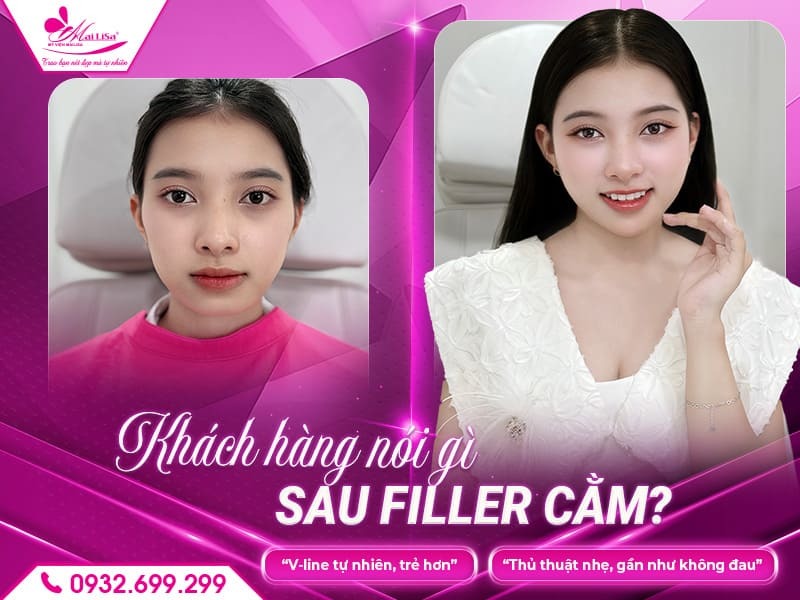 tiem-filler-cam-co-lam-cam-thon-gon-khong