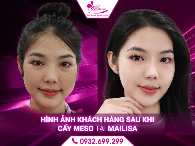 nguyen-nhan-gay-u-hat-sau-cay-meso
