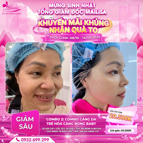 combo 2 - combo căng da trẻ hóa căng bóng baby