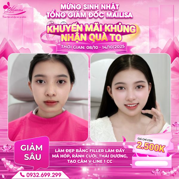 làm đẹp bằng filler làm đầy má hóp, rãnh cười, thái dương, tiêm cằm 1 cc