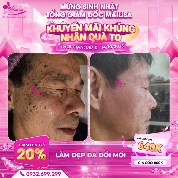 làm đẹp da đồi mồi