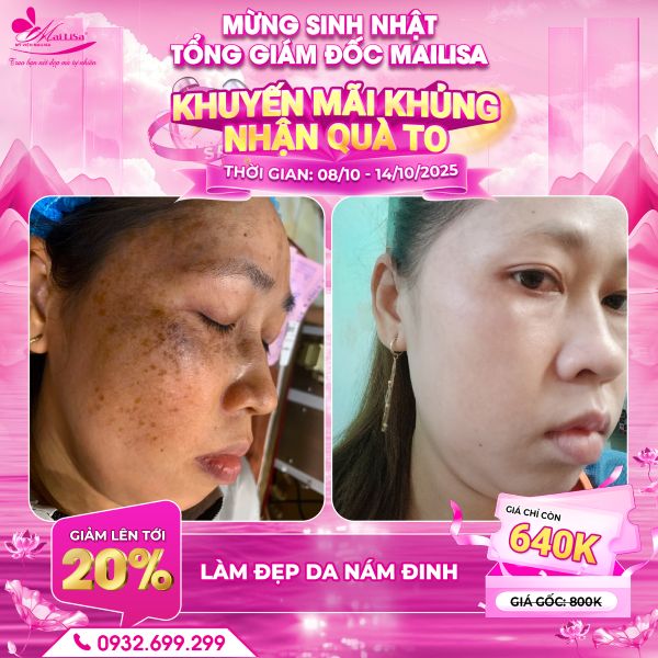 làm đẹp da nám đinh