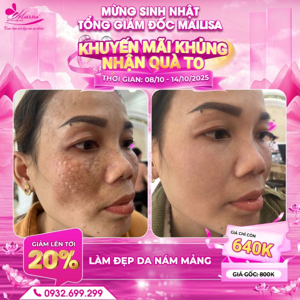 làm đẹp da nám mảng
